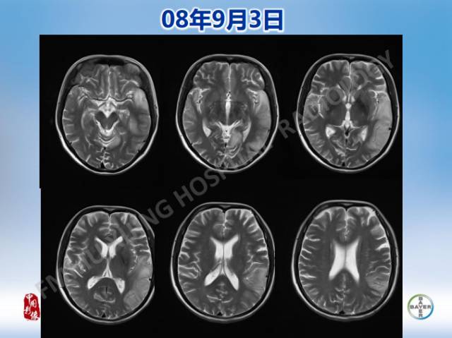 【病例】线粒体脑肌病1例MR影像表现
