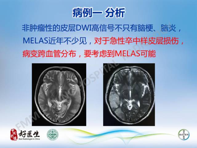 【病例】线粒体脑肌病1例MR影像表现