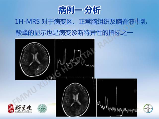 【病例】线粒体脑肌病1例MR影像表现