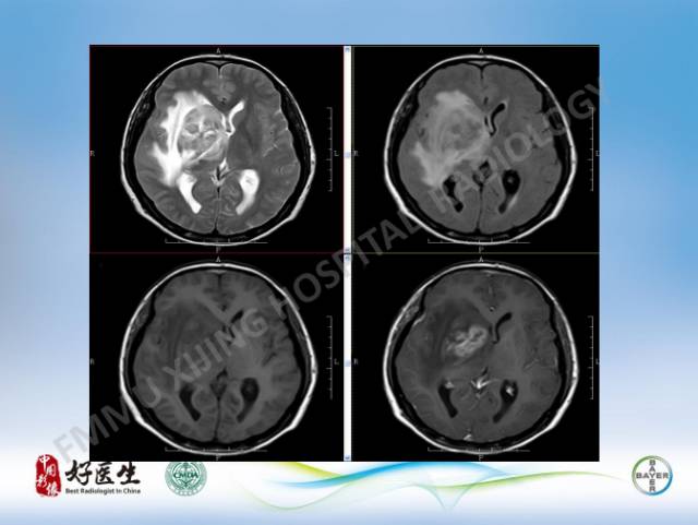 【病例】原发性中枢神经系统淋巴瘤1例MR影像表现