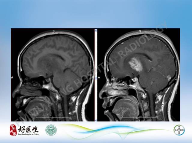 【病例】原发性中枢神经系统淋巴瘤1例MR影像表现