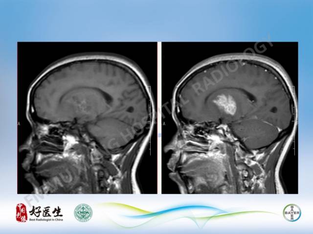 【病例】原发性中枢神经系统淋巴瘤1例MR影像表现