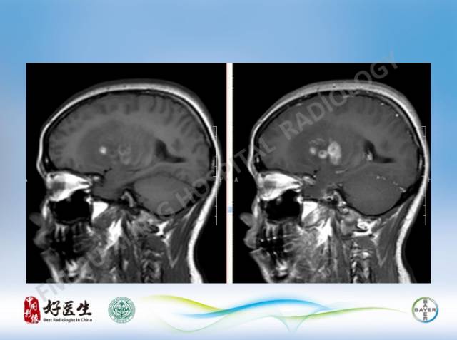 【病例】原发性中枢神经系统淋巴瘤1例MR影像表现