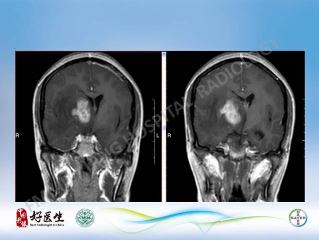 【病例】原发性中枢神经系统淋巴瘤1例MR影像表现