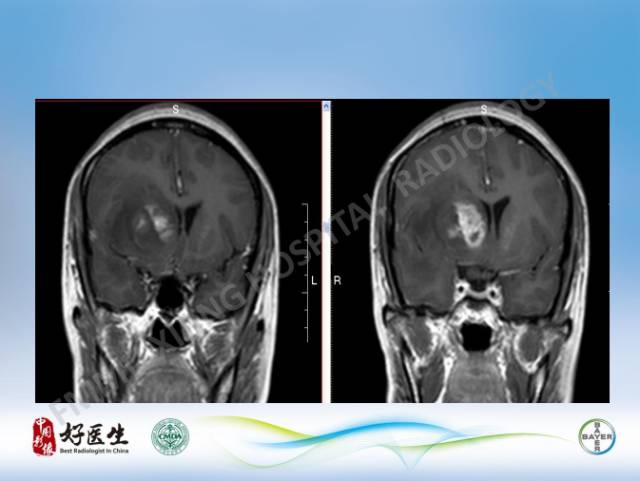 【病例】原发性中枢神经系统淋巴瘤1例MR影像表现