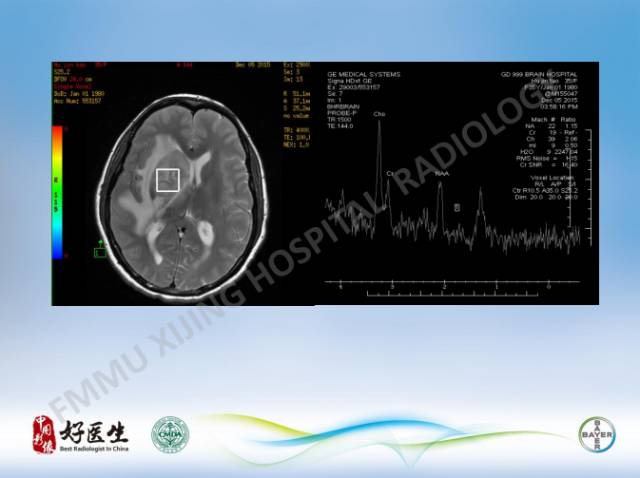 【病例】原发性中枢神经系统淋巴瘤1例MR影像表现