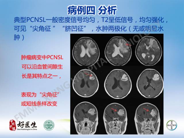 【病例】原发性中枢神经系统淋巴瘤1例MR影像表现