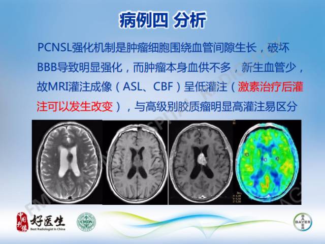 【病例】原发性中枢神经系统淋巴瘤1例MR影像表现