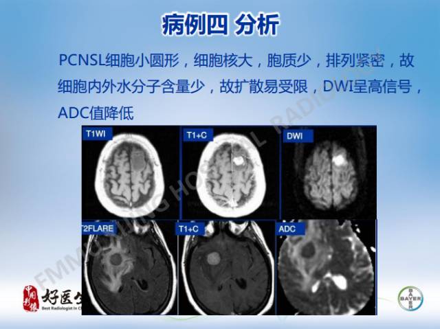 【病例】原发性中枢神经系统淋巴瘤1例MR影像表现