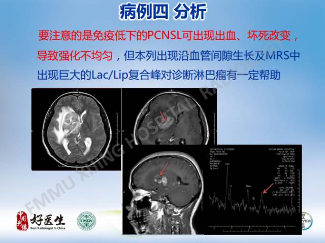 【病例】原发性中枢神经系统淋巴瘤1例MR影像表现