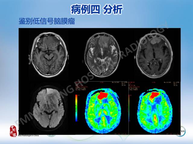 【病例】原发性中枢神经系统淋巴瘤1例MR影像表现