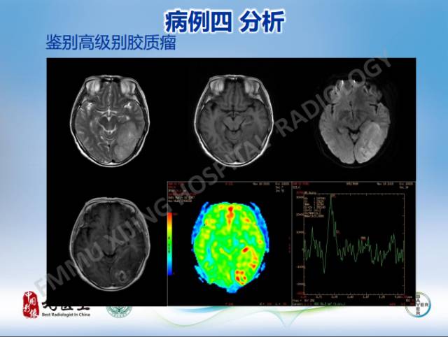 【病例】原发性中枢神经系统淋巴瘤1例MR影像表现