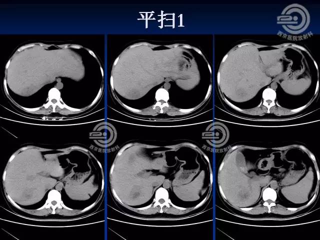 【病例】肝脏寄生虫感染嗜酸性肉芽肿1例CT影像表现