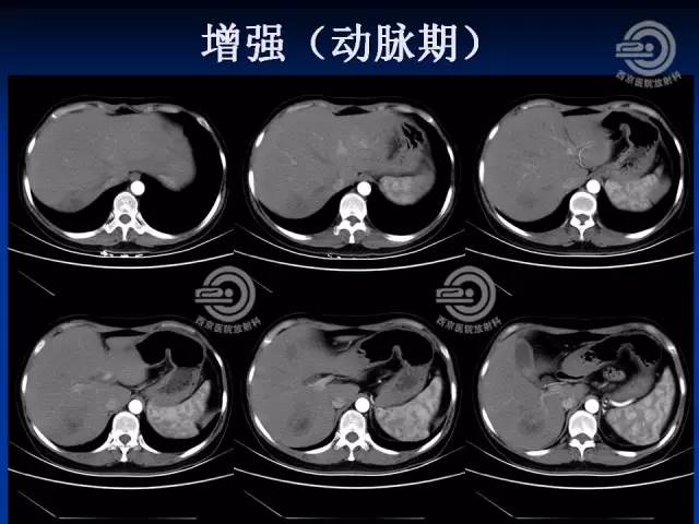 【病例】肝脏寄生虫感染嗜酸性肉芽肿1例CT影像表现