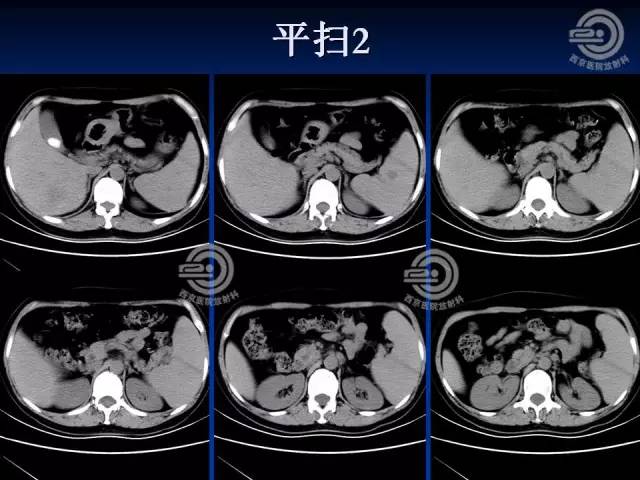 【病例】肝脏寄生虫感染嗜酸性肉芽肿1例CT影像表现