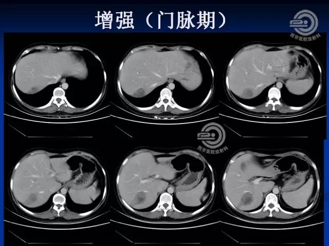 【病例】肝脏寄生虫感染嗜酸性肉芽肿1例CT影像表现