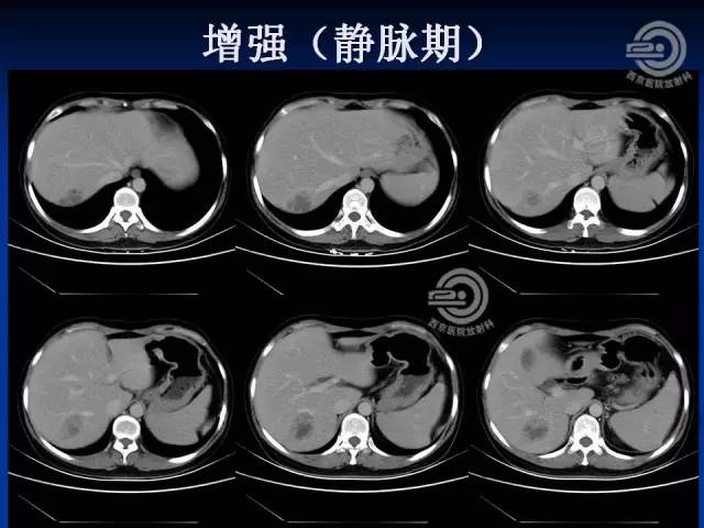 【病例】肝脏寄生虫感染嗜酸性肉芽肿1例CT影像表现
