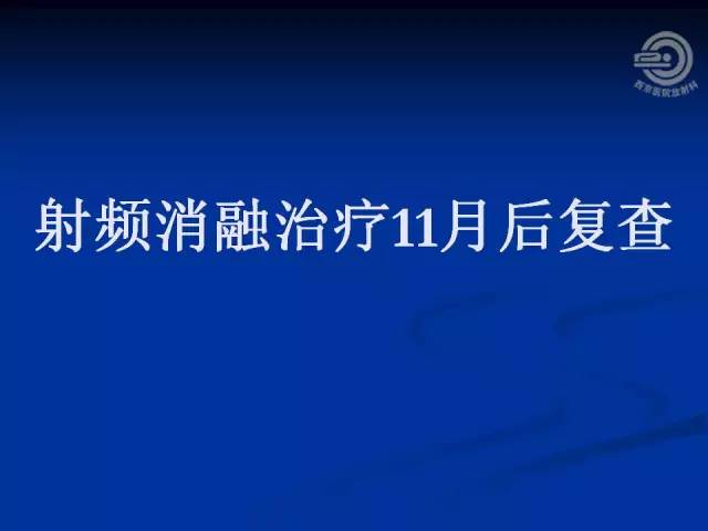 【病例】肝脏寄生虫感染嗜酸性肉芽肿1例CT影像表现