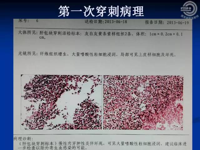 【病例】肝脏寄生虫感染嗜酸性肉芽肿1例CT影像表现