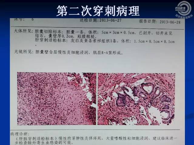 【病例】肝脏寄生虫感染嗜酸性肉芽肿1例CT影像表现