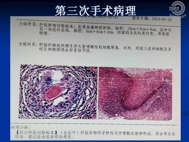 【病例】肝脏寄生虫感染嗜酸性肉芽肿1例CT影像表现
