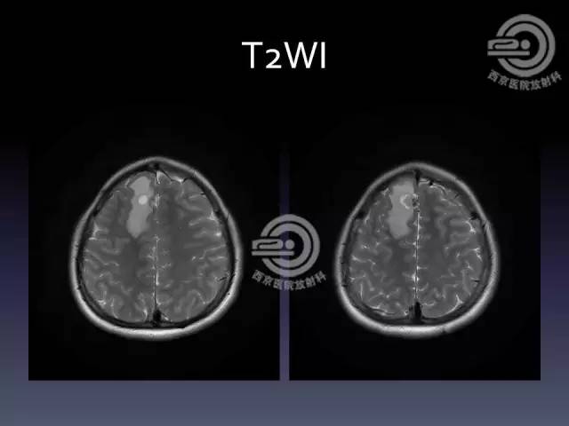 【病例】右额叶多形性黄色星形细胞瘤1例MR影像表现