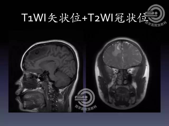 【病例】右额叶多形性黄色星形细胞瘤1例MR影像表现