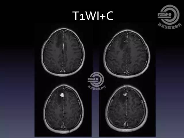 【病例】右额叶多形性黄色星形细胞瘤1例MR影像表现