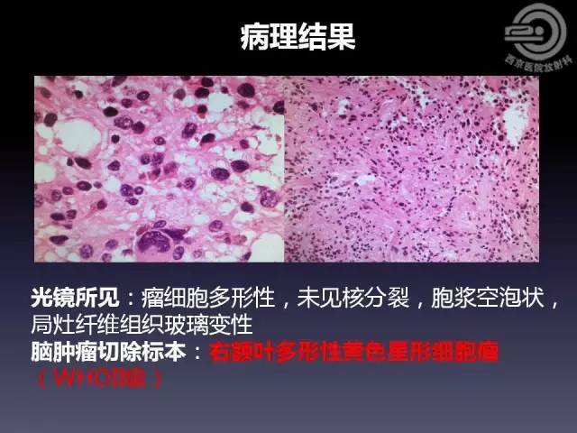 【病例】右额叶多形性黄色星形细胞瘤1例MR影像表现