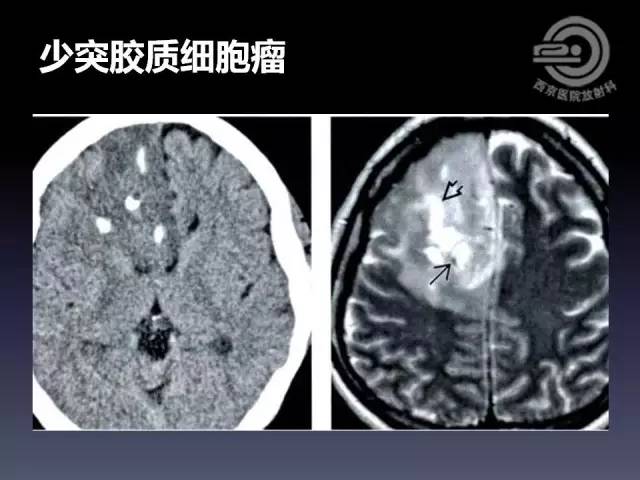 【病例】右额叶多形性黄色星形细胞瘤1例MR影像表现