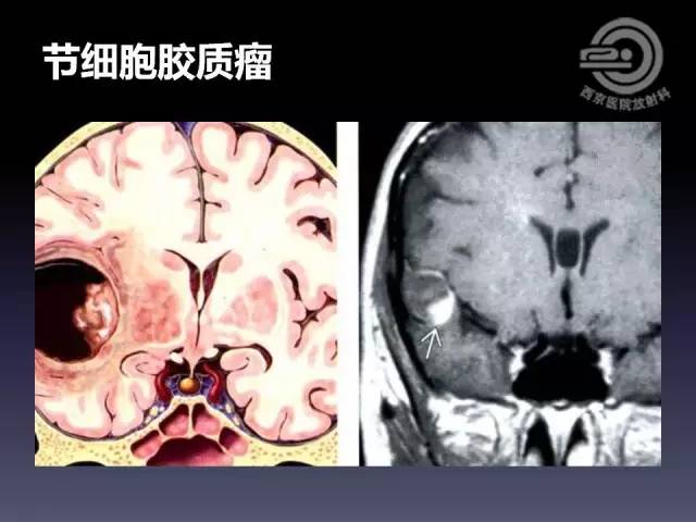 【病例】右额叶多形性黄色星形细胞瘤1例MR影像表现