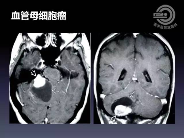 【病例】右额叶多形性黄色星形细胞瘤1例MR影像表现