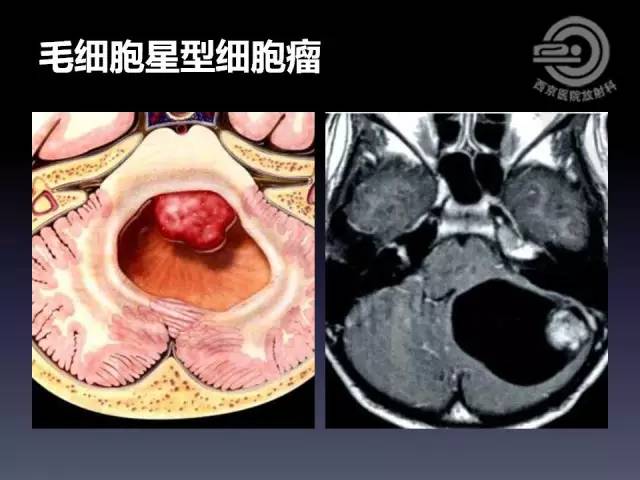 【病例】右额叶多形性黄色星形细胞瘤1例MR影像表现