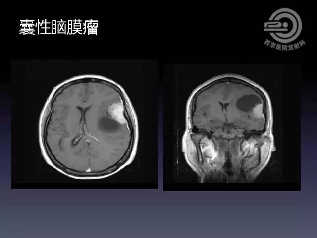 【病例】右额叶多形性黄色星形细胞瘤1例MR影像表现