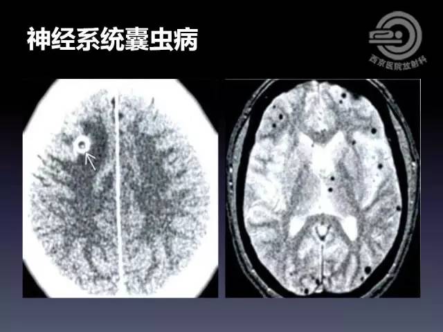 【病例】右额叶多形性黄色星形细胞瘤1例MR影像表现