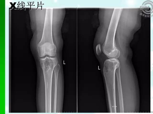 【病例】胫骨软骨粘液样纤维瘤1例影像表现