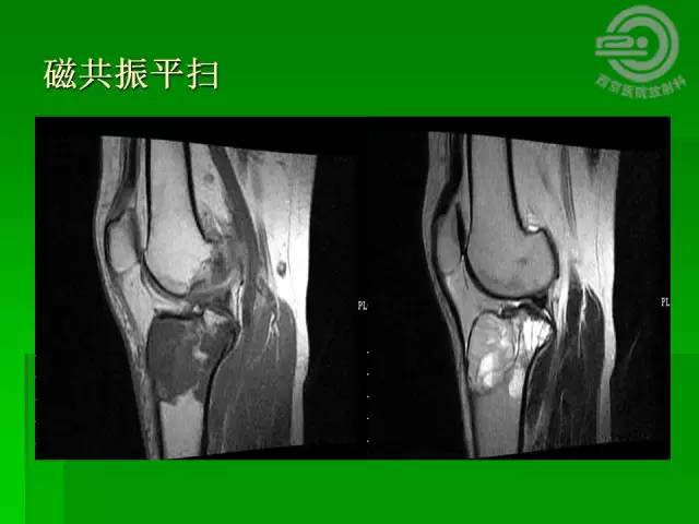 【病例】胫骨软骨粘液样纤维瘤1例影像表现