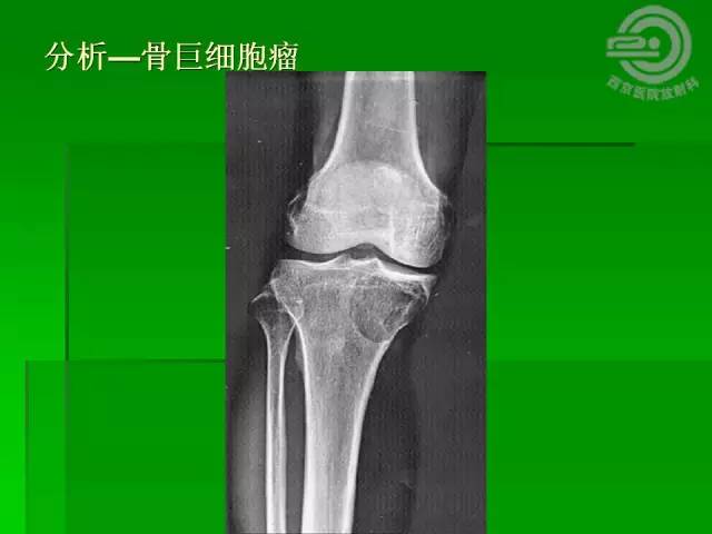 【病例】胫骨软骨粘液样纤维瘤1例影像表现