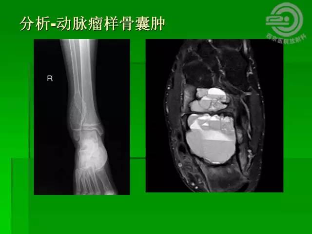 【病例】胫骨软骨粘液样纤维瘤1例影像表现