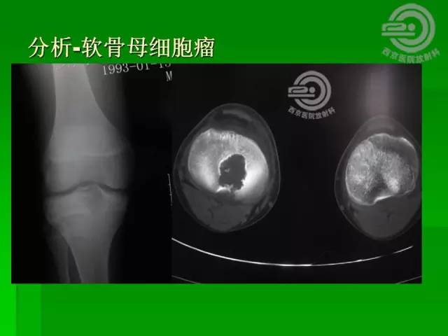 【病例】胫骨软骨粘液样纤维瘤1例影像表现