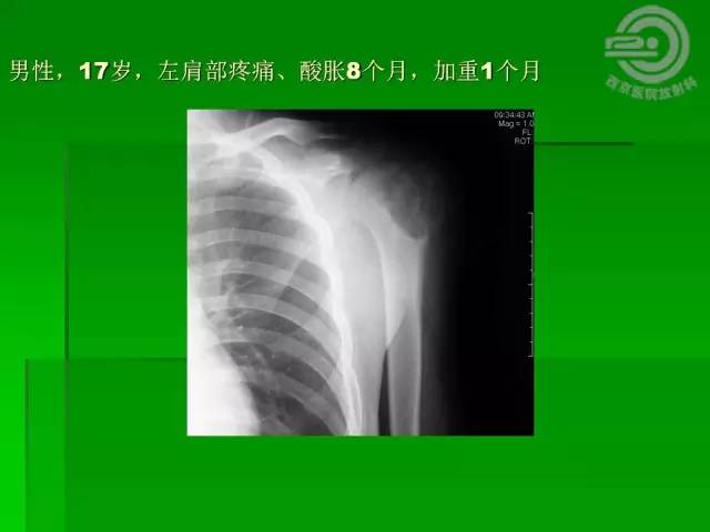 【病例】胫骨软骨粘液样纤维瘤1例影像表现