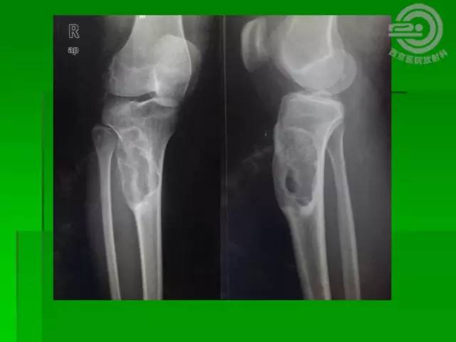 【病例】胫骨软骨粘液样纤维瘤1例影像表现