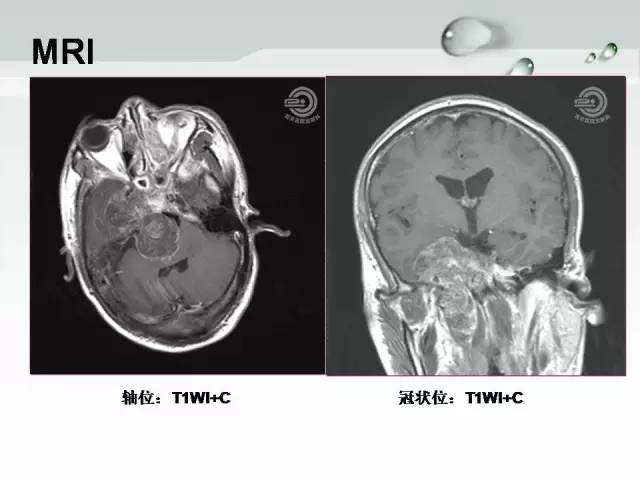 【病例】颅底软骨肉瘤1例CT及MR影像表现