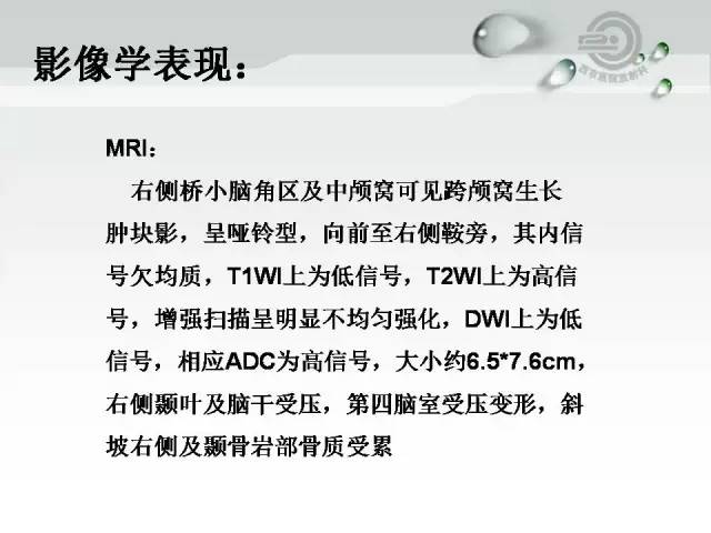 【病例】颅底软骨肉瘤1例CT及MR影像表现