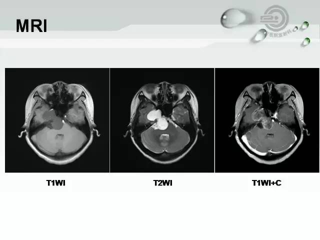 【病例】颅底软骨肉瘤1例CT及MR影像表现