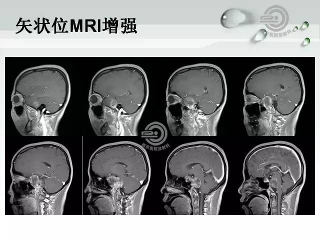 【病例】颅底软骨肉瘤1例CT及MR影像表现