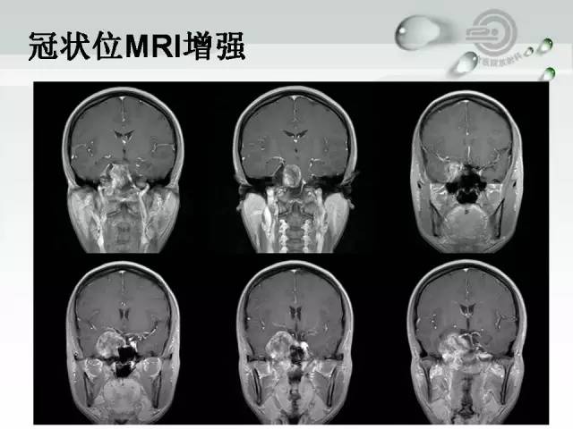 【病例】颅底软骨肉瘤1例CT及MR影像表现