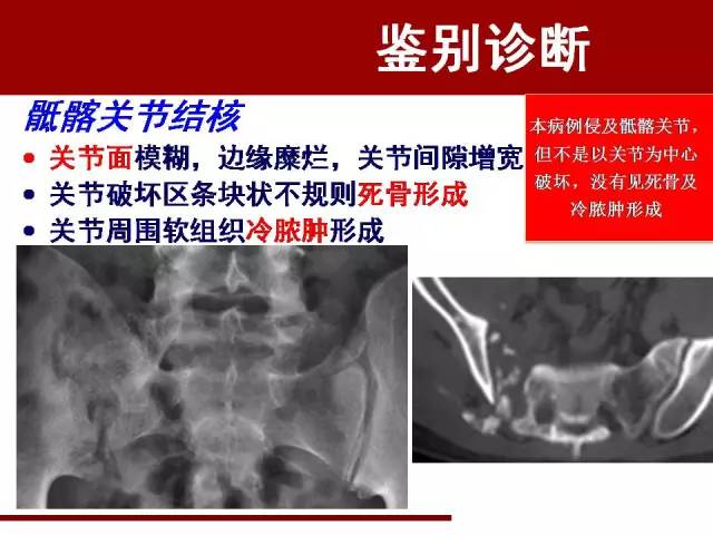 【病例】骶髂关节滑膜肉瘤1例影像表现 【病例】骶髂关节滑膜肉瘤1例影像表现