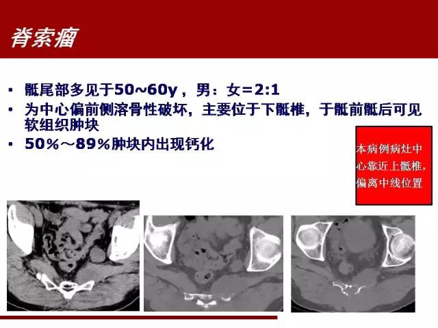 【病例】骶髂关节滑膜肉瘤1例影像表现 【病例】骶髂关节滑膜肉瘤1例影像表现