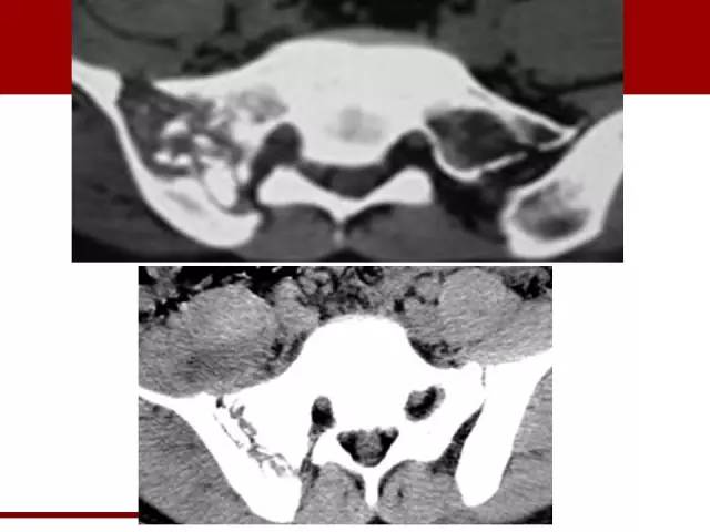 【病例】骶髂关节滑膜肉瘤1例影像表现 【病例】骶髂关节滑膜肉瘤1例影像表现